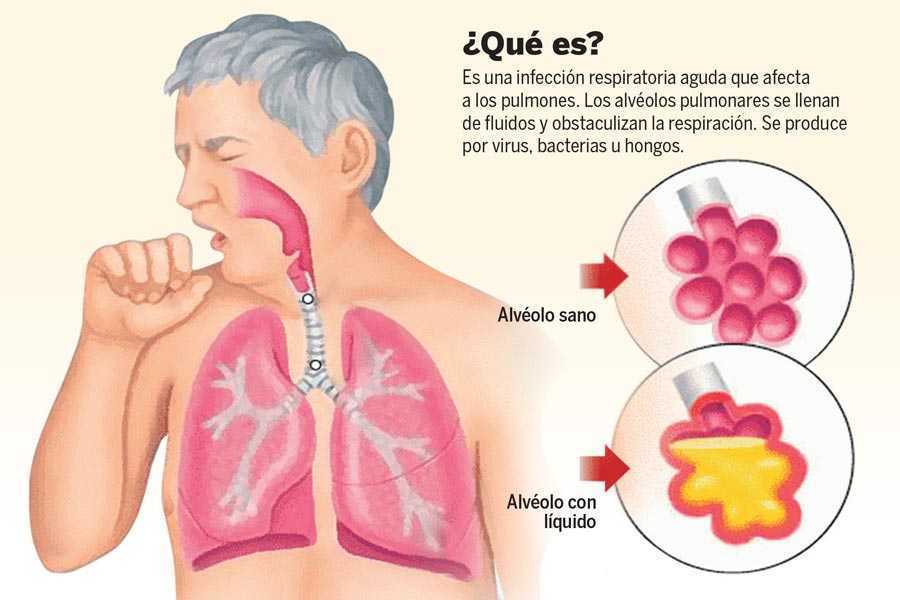 Se recomienda proteger a niños y adultos mayores contra neumococo